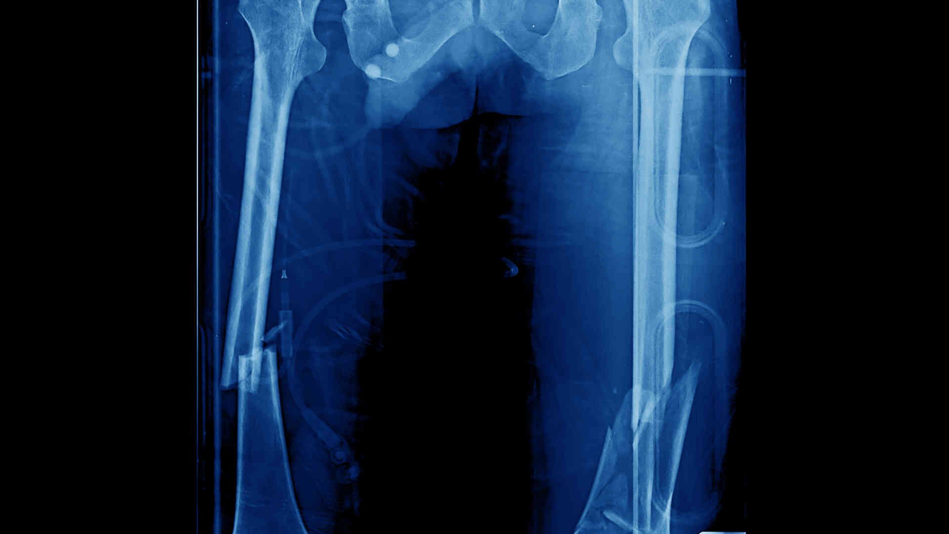 Imaging of bilateral femoral fractures