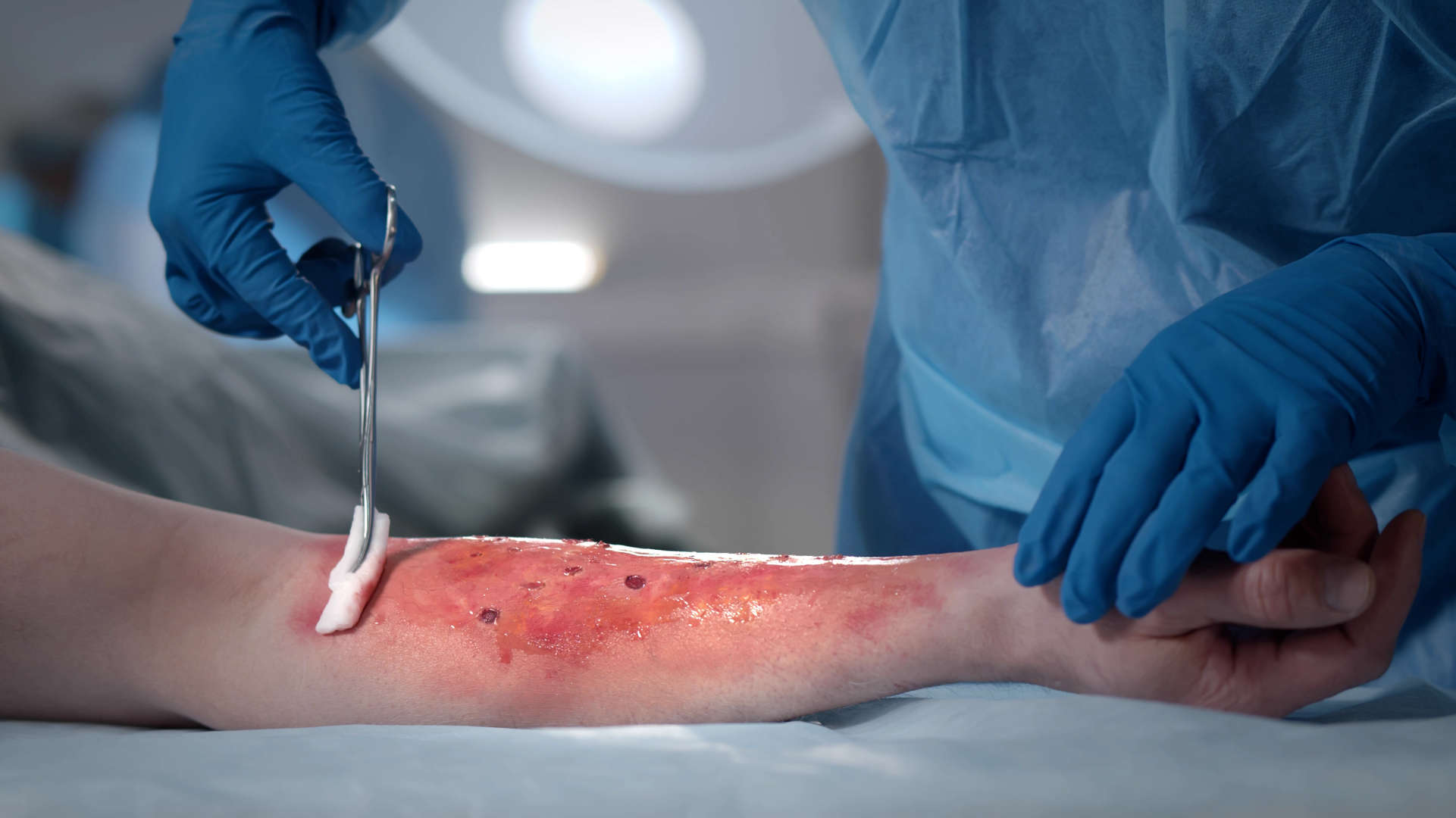 Burns wound being cleaned in theatre