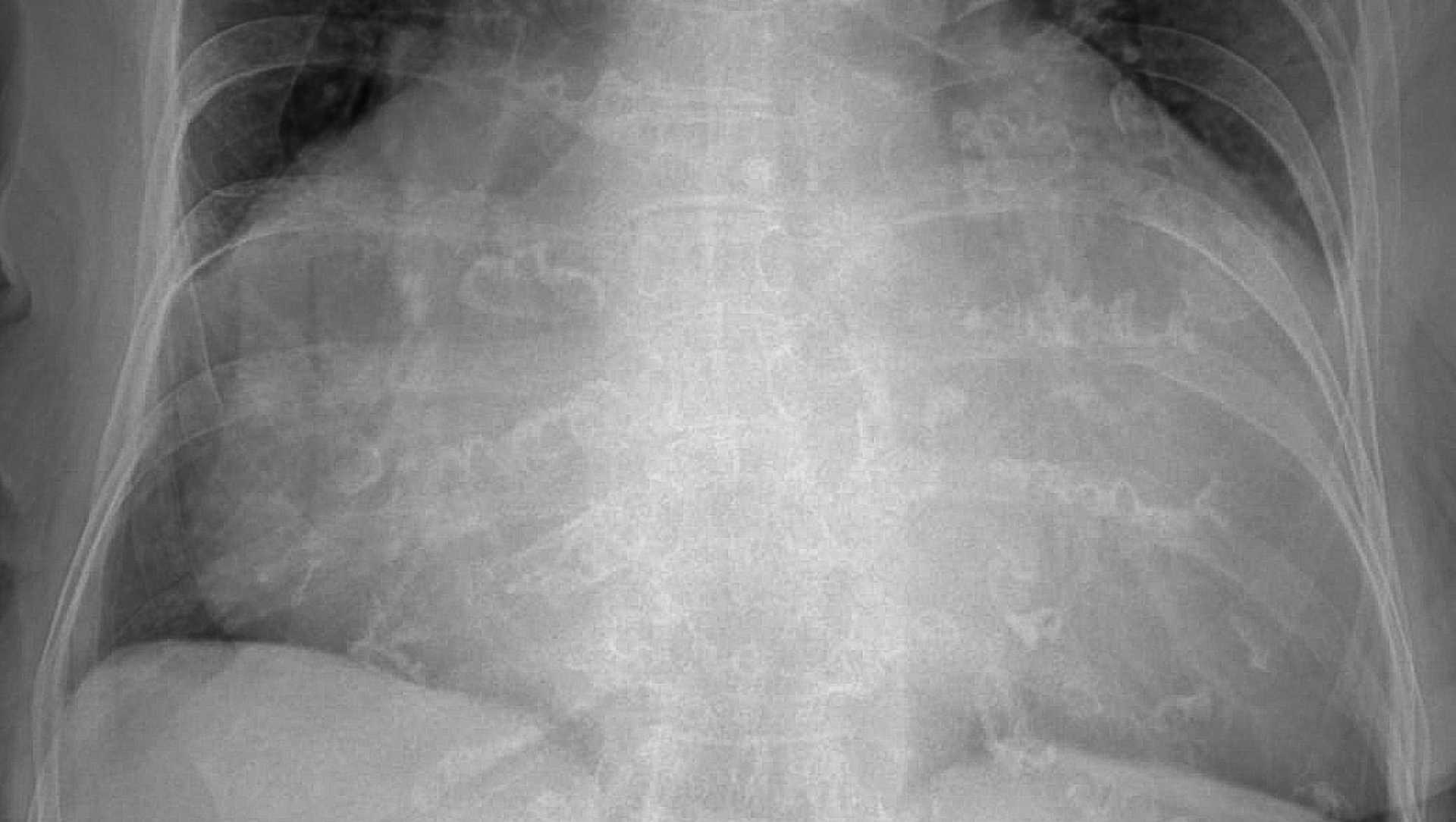 Large pericardial effusion