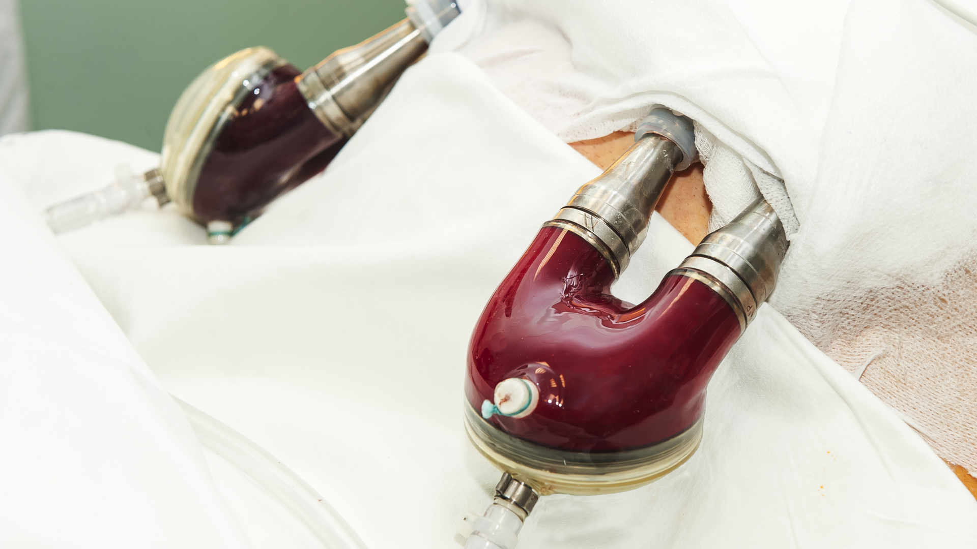 ventricular assist devices