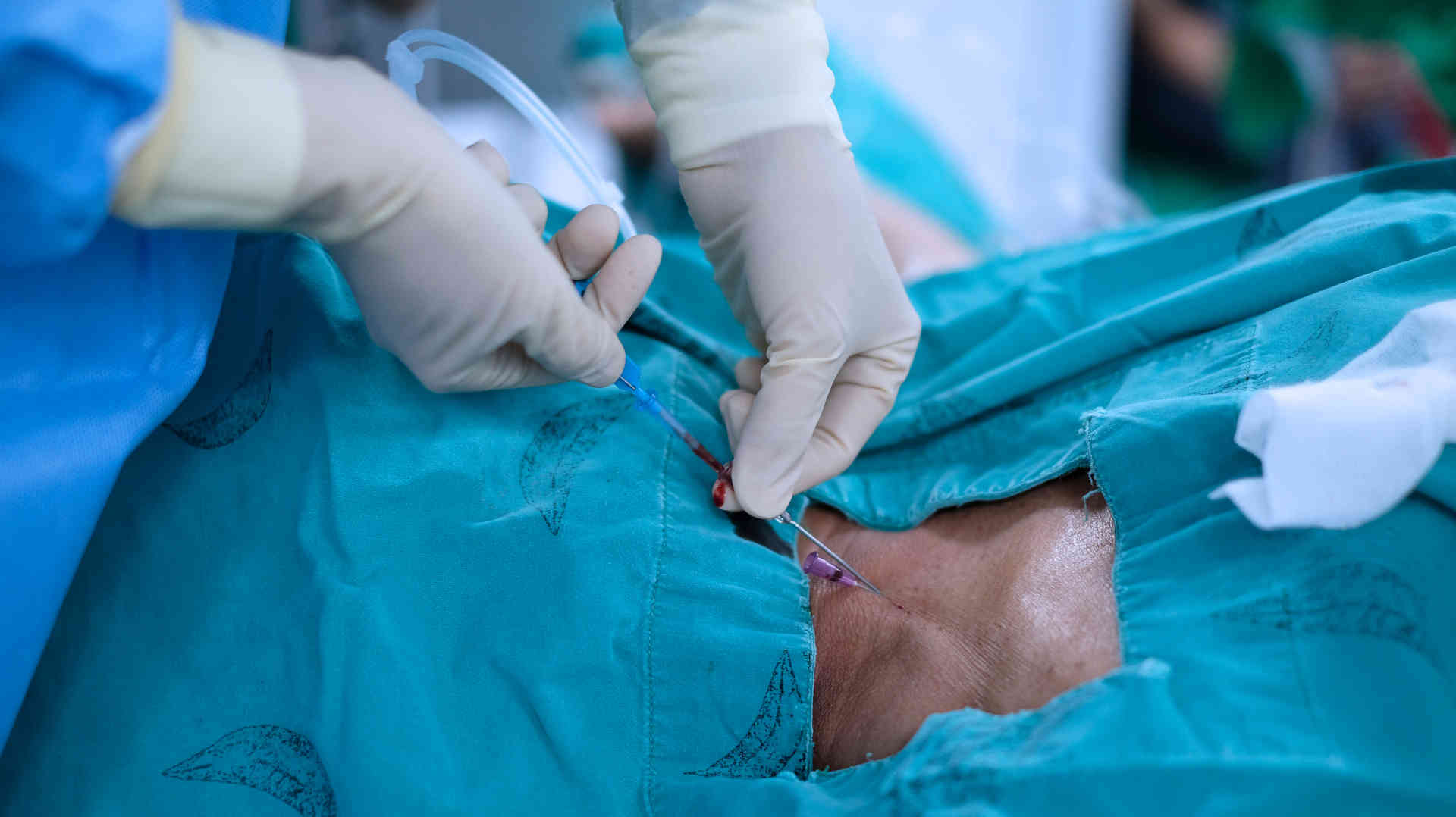 Right internal vein cannulation