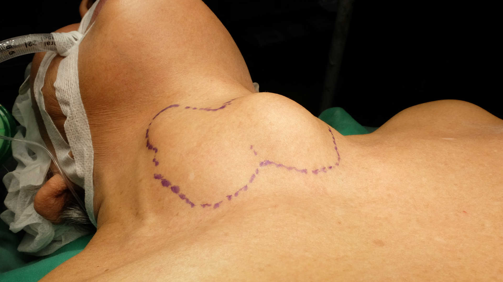 Patient with thryroid goitre being prepared for surgery