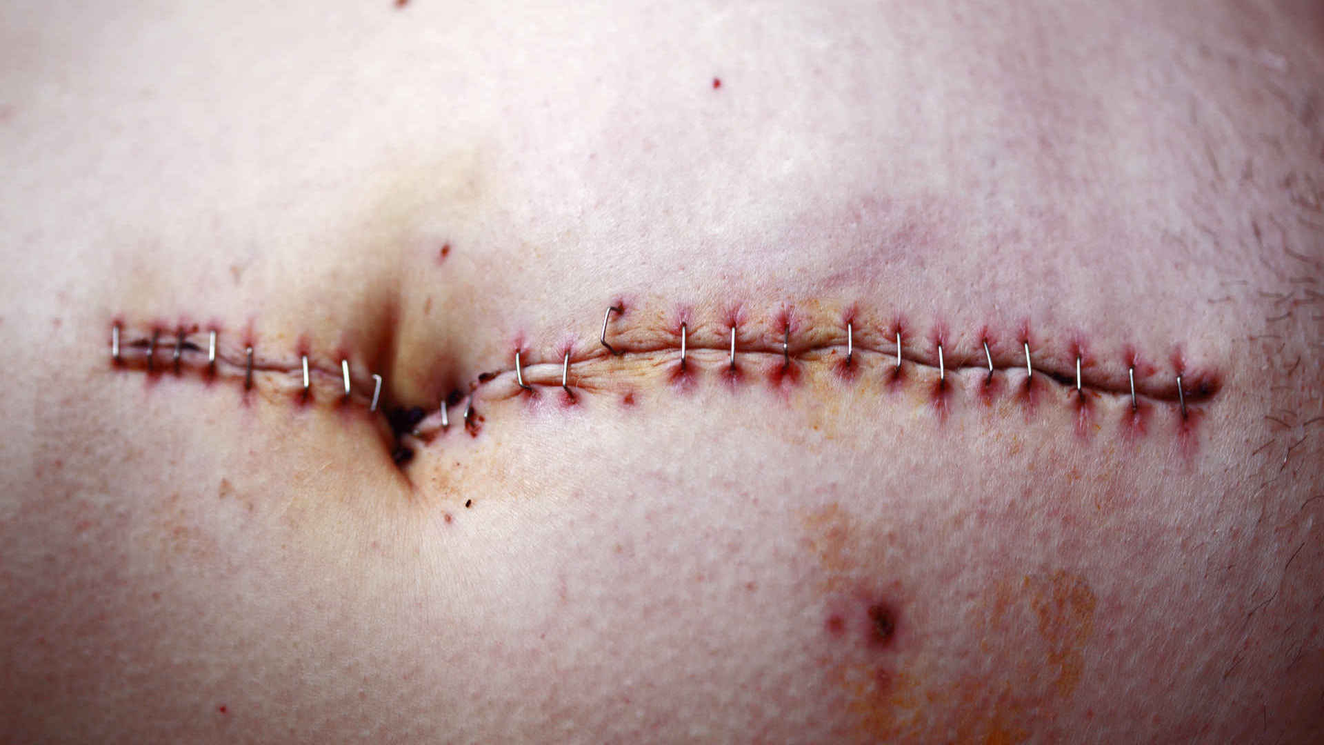 Laparotomy wound