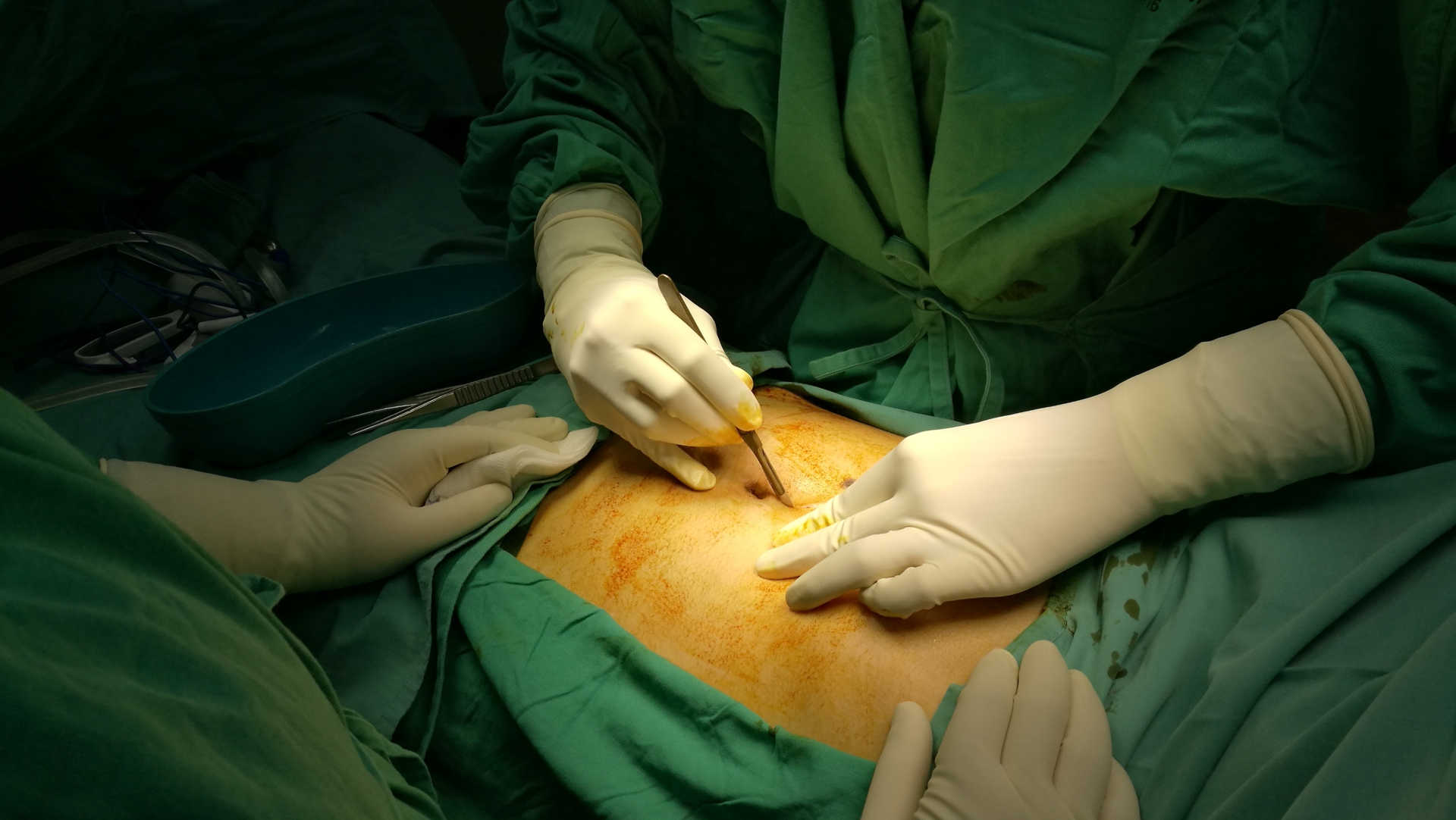 laparotomy incision