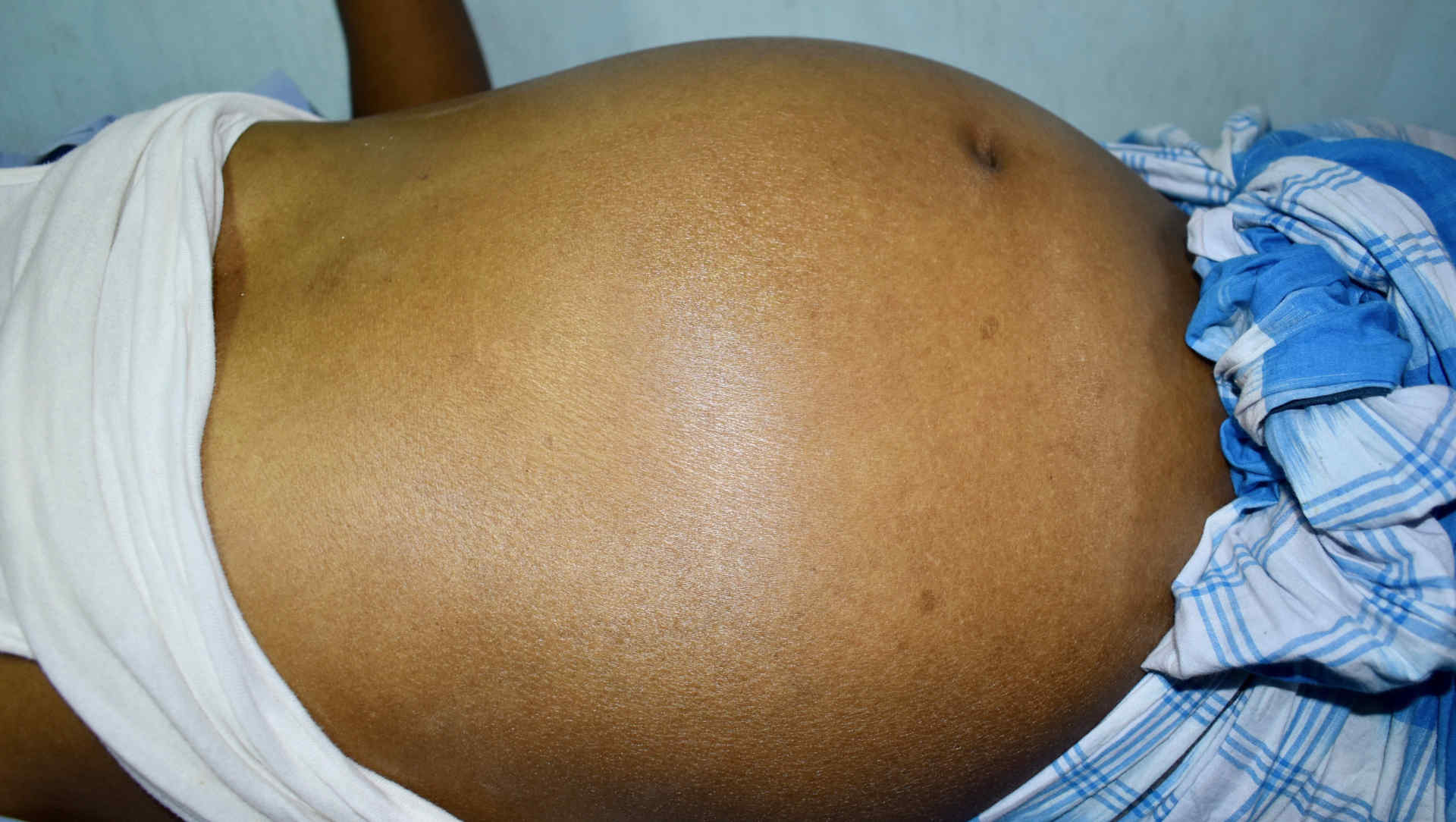 Distended ascitic abdomen