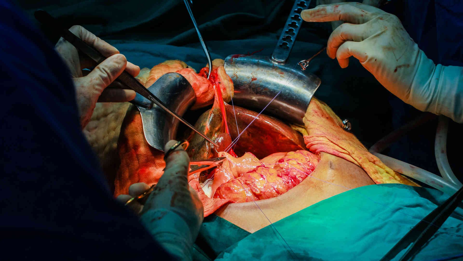 Liver transplant operation
