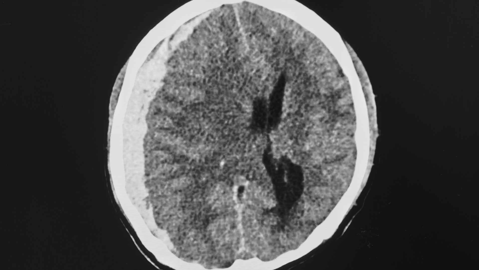 Subdural haematoma