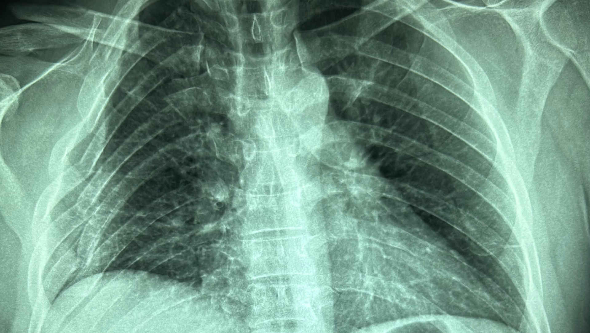 Chest radiograph showing multiple rib fractures