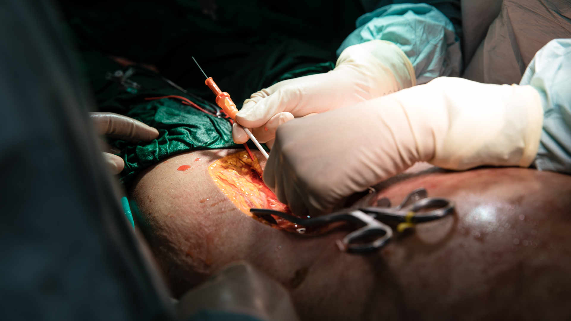 REBOA Cannulation