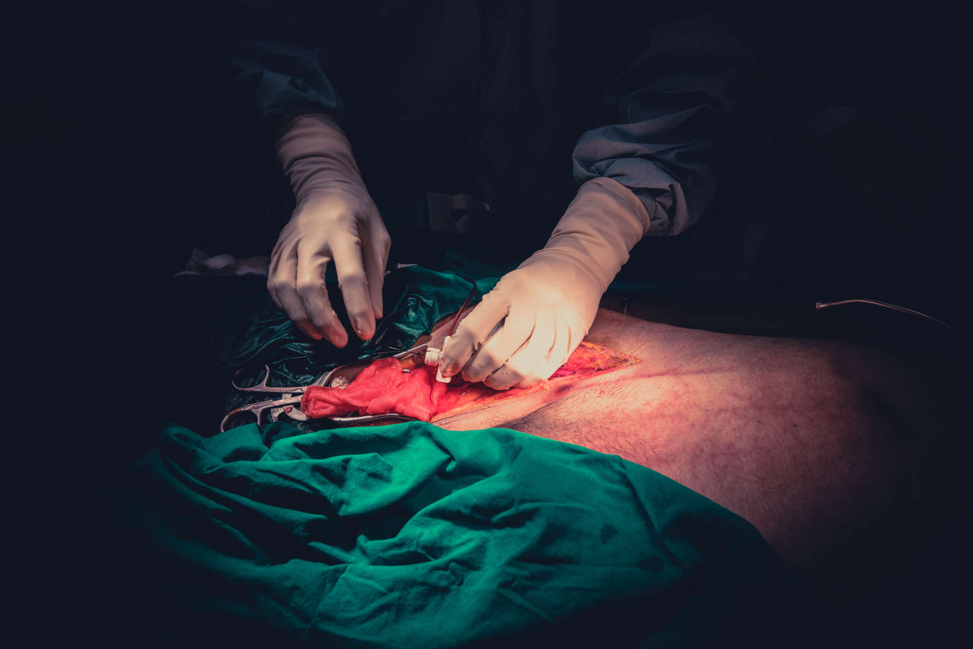 REBOA cannulation
