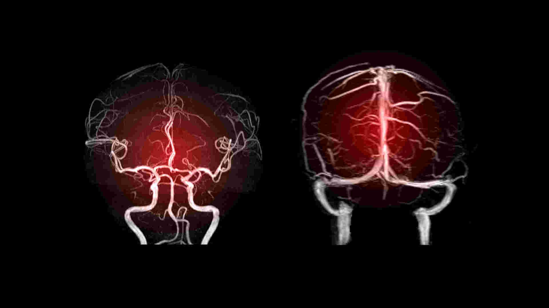 Brain MRA & MRV