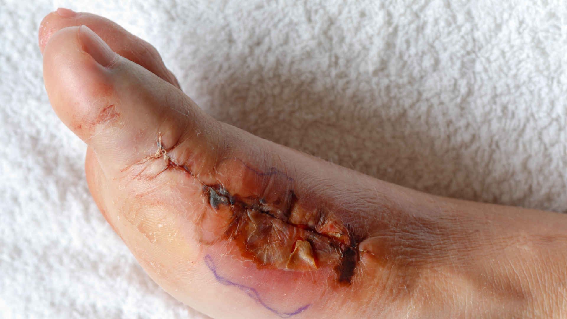 Foot wound infection