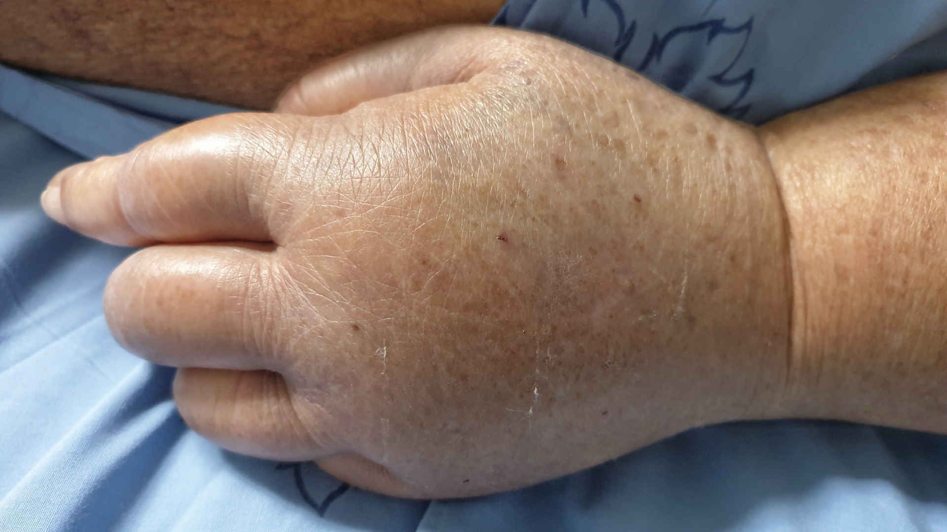 Oedematous hand of a patient with fluid overload