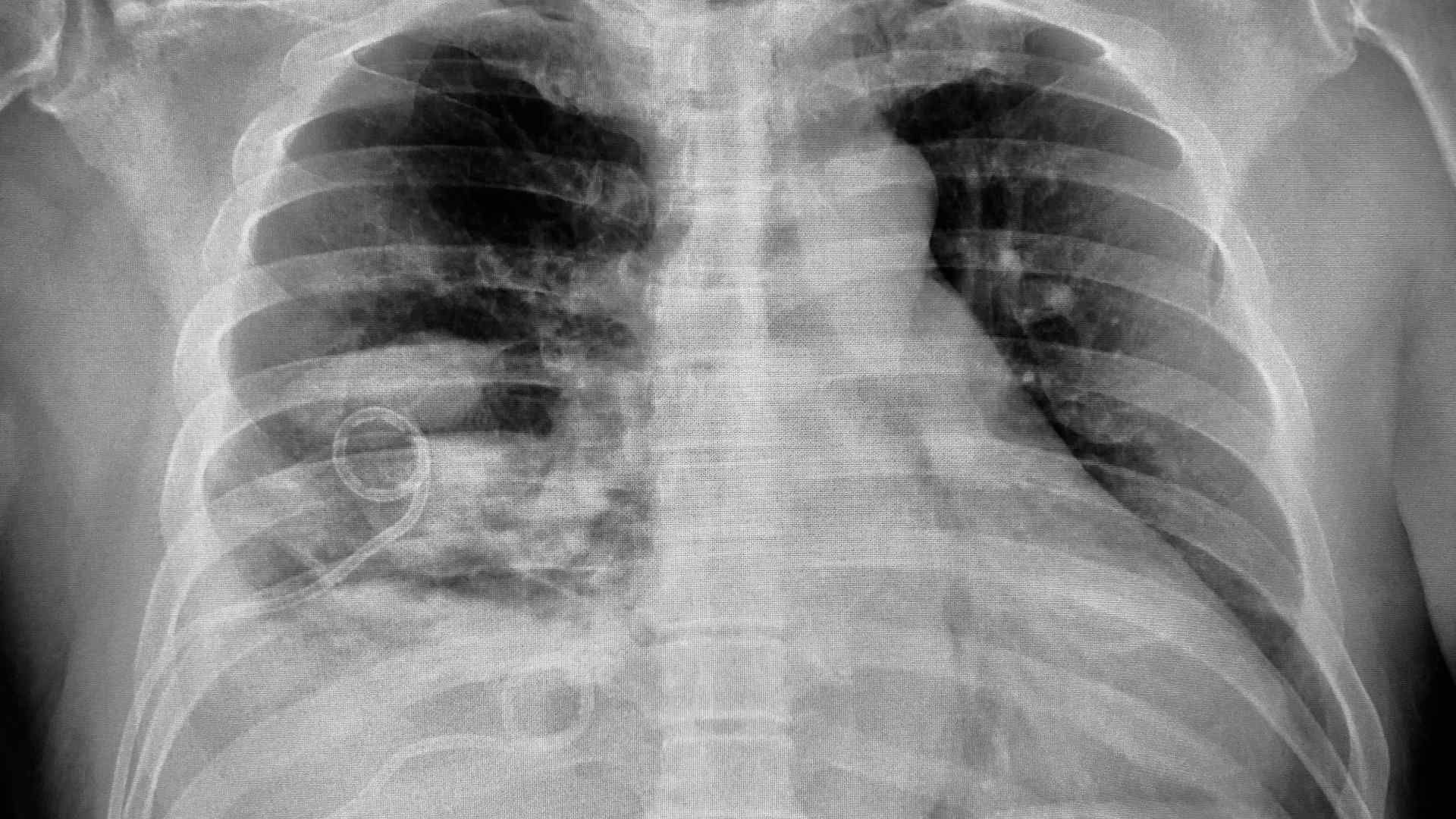 Chest radiograph showing pleural space infection 