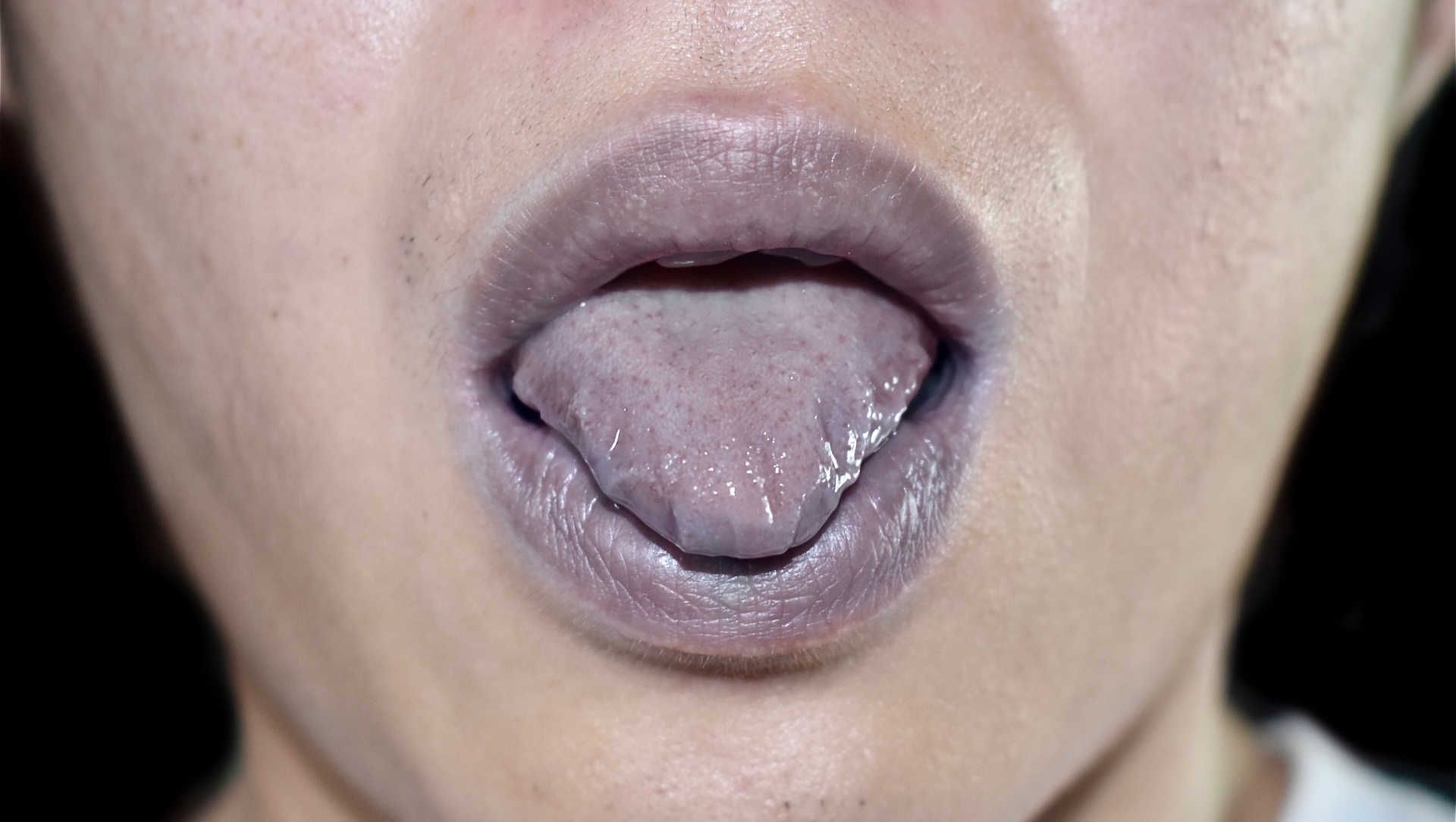 Ventilated patient in the ICU