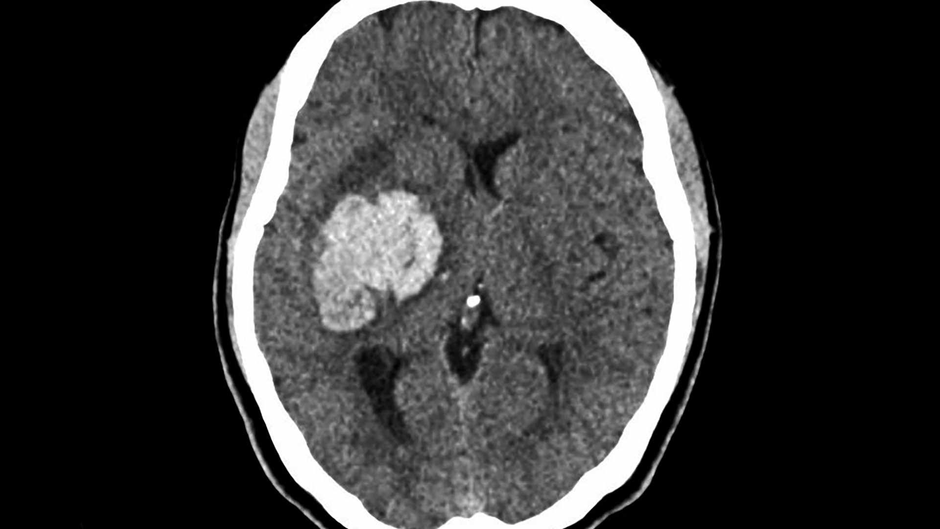 Right-sided intracerebral haemorrhage