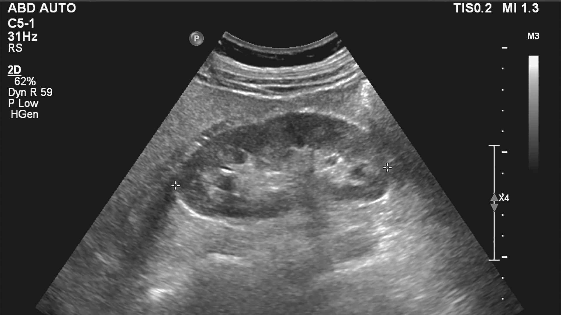 Ultrasound scan of a kidney