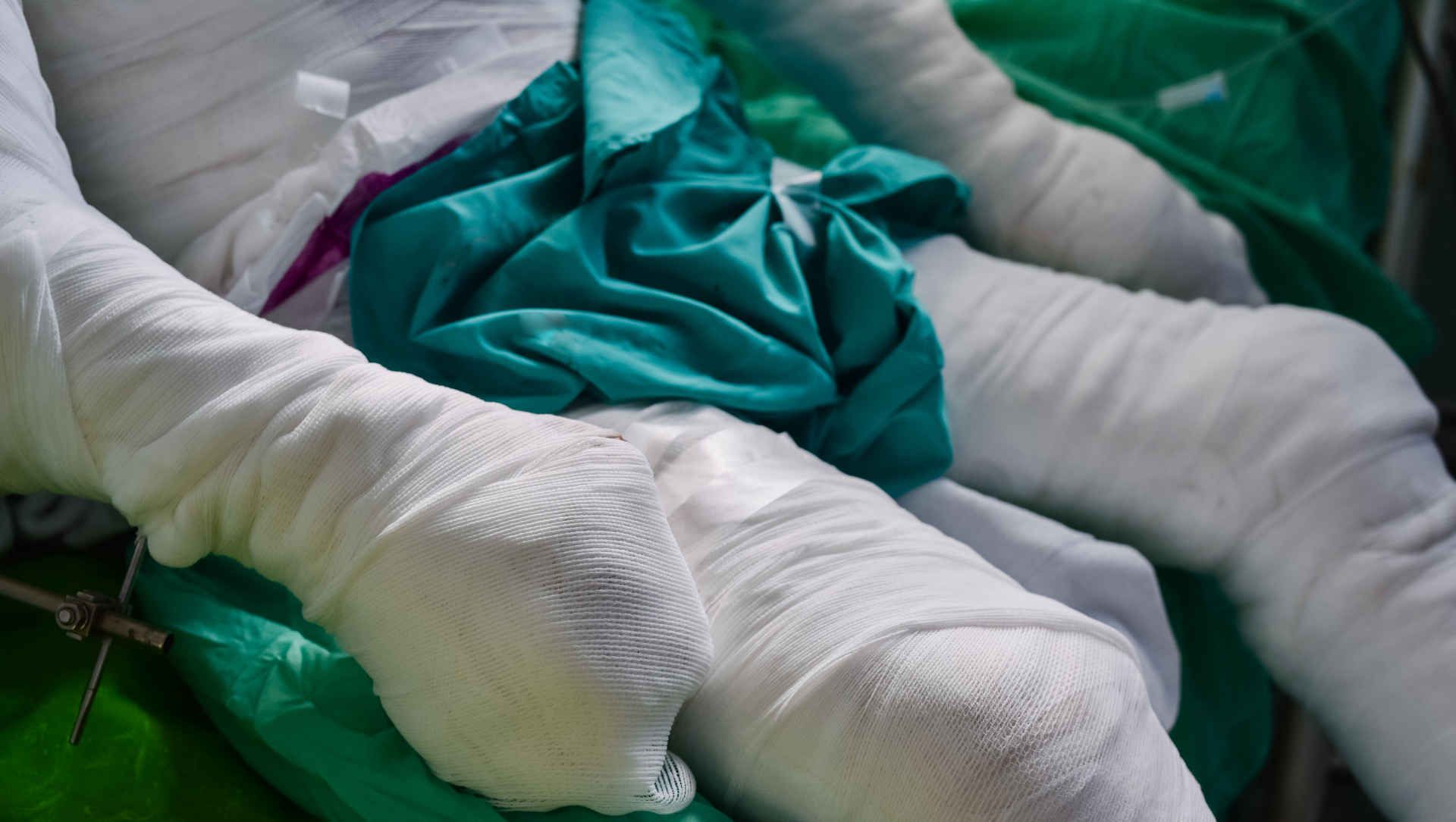 Burns patient dressed infull body length bandages