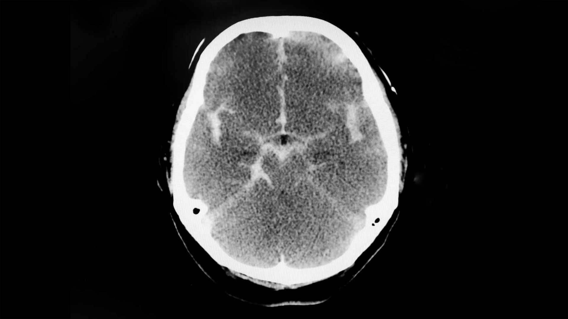 CT scan showing subarchnoid haemorrhage