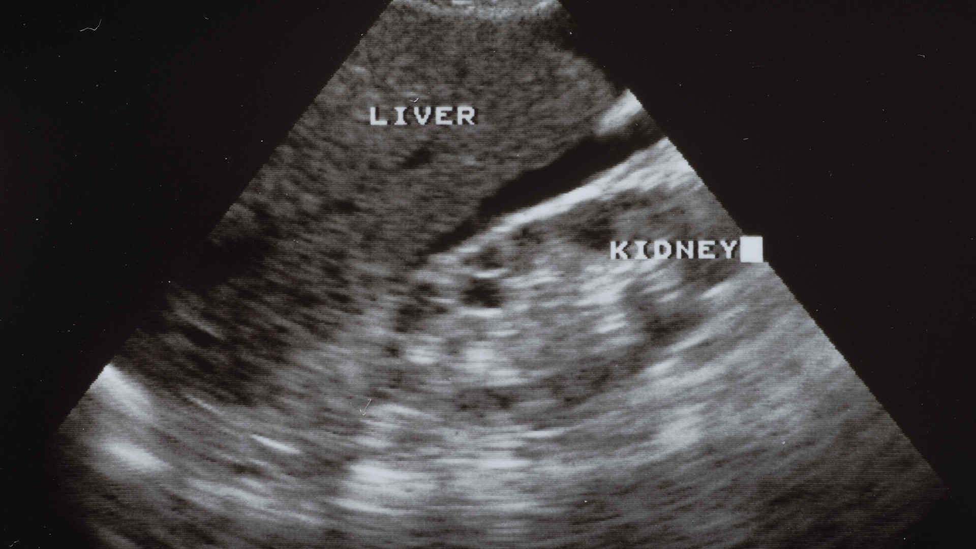 Bruising across a patient's lower abdomen