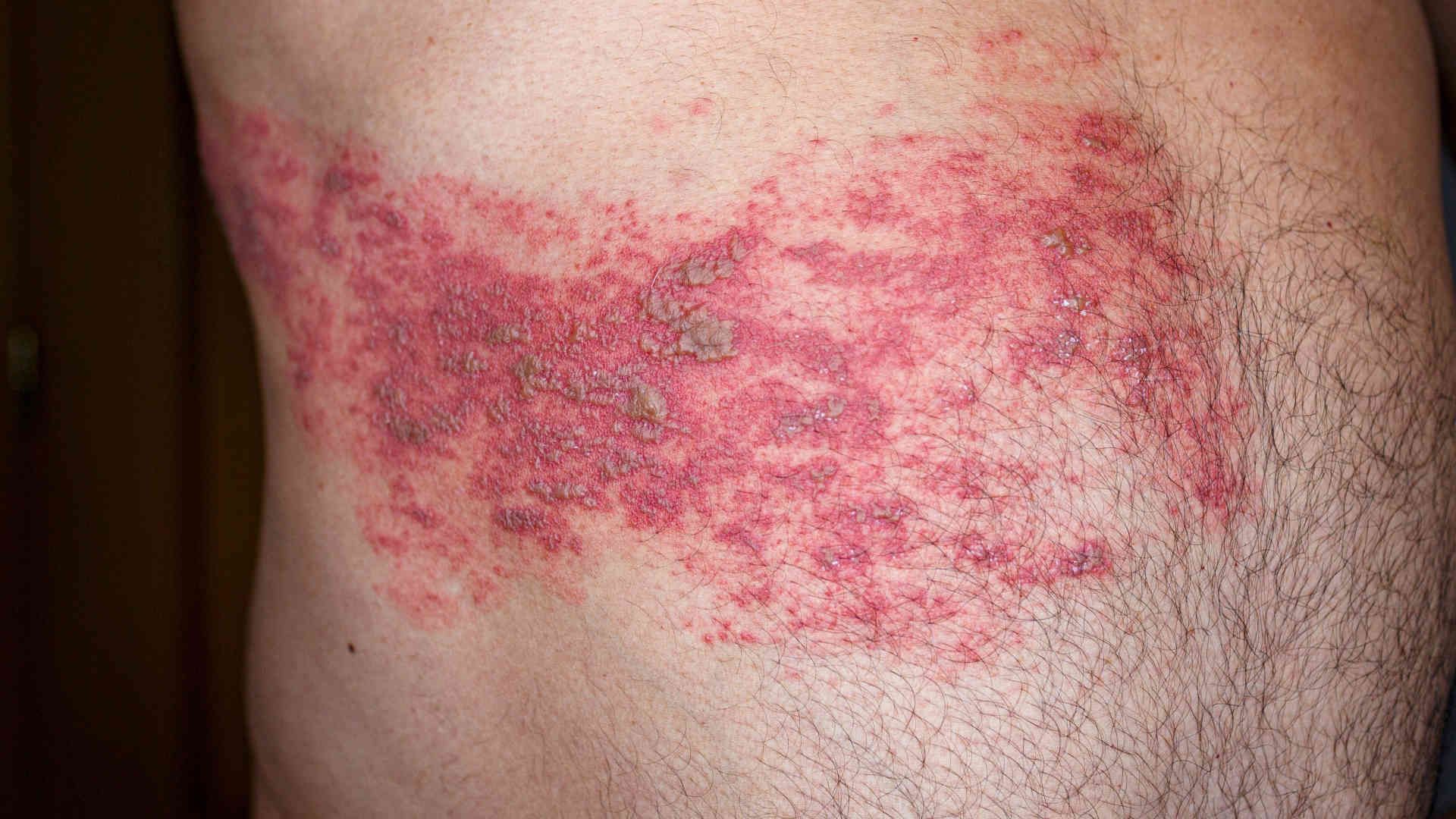 Shingles rash on patients flank from varicella zooster recurrence