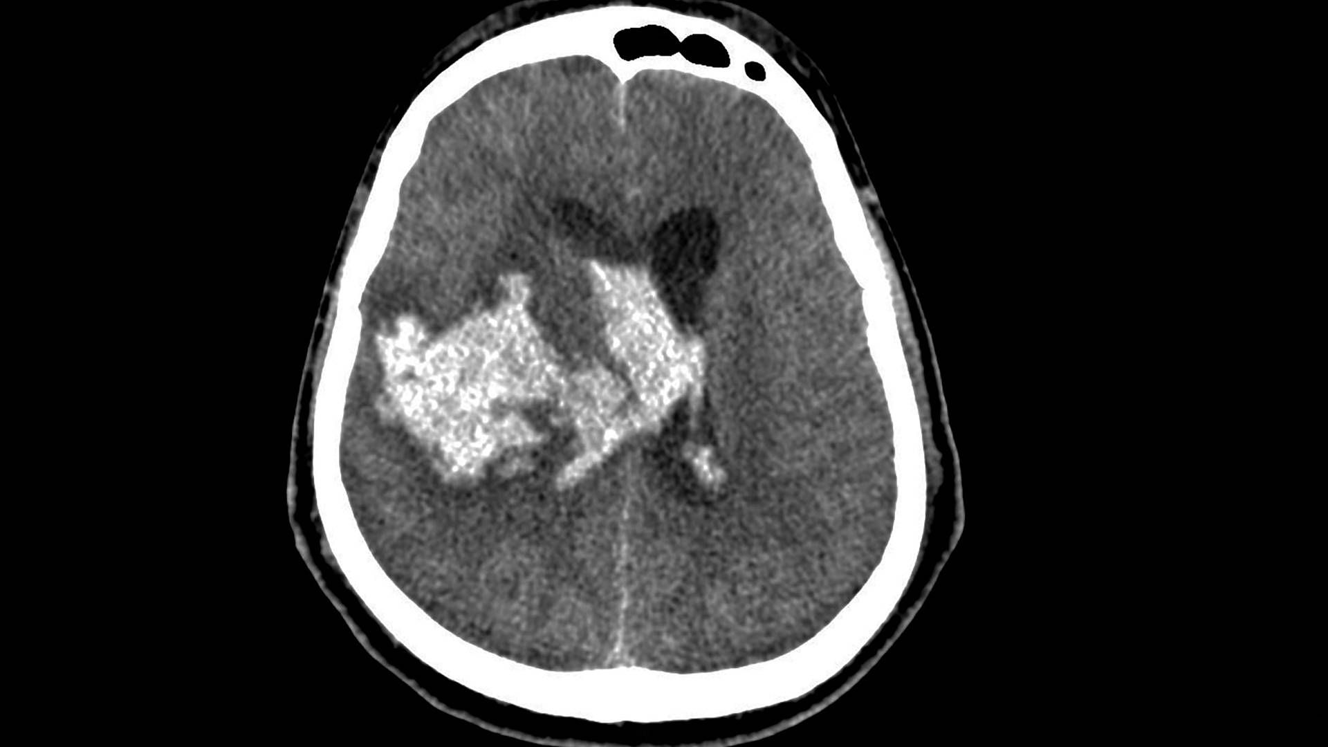 Right-sided intracerebral haemorrhage with intraventricular extension