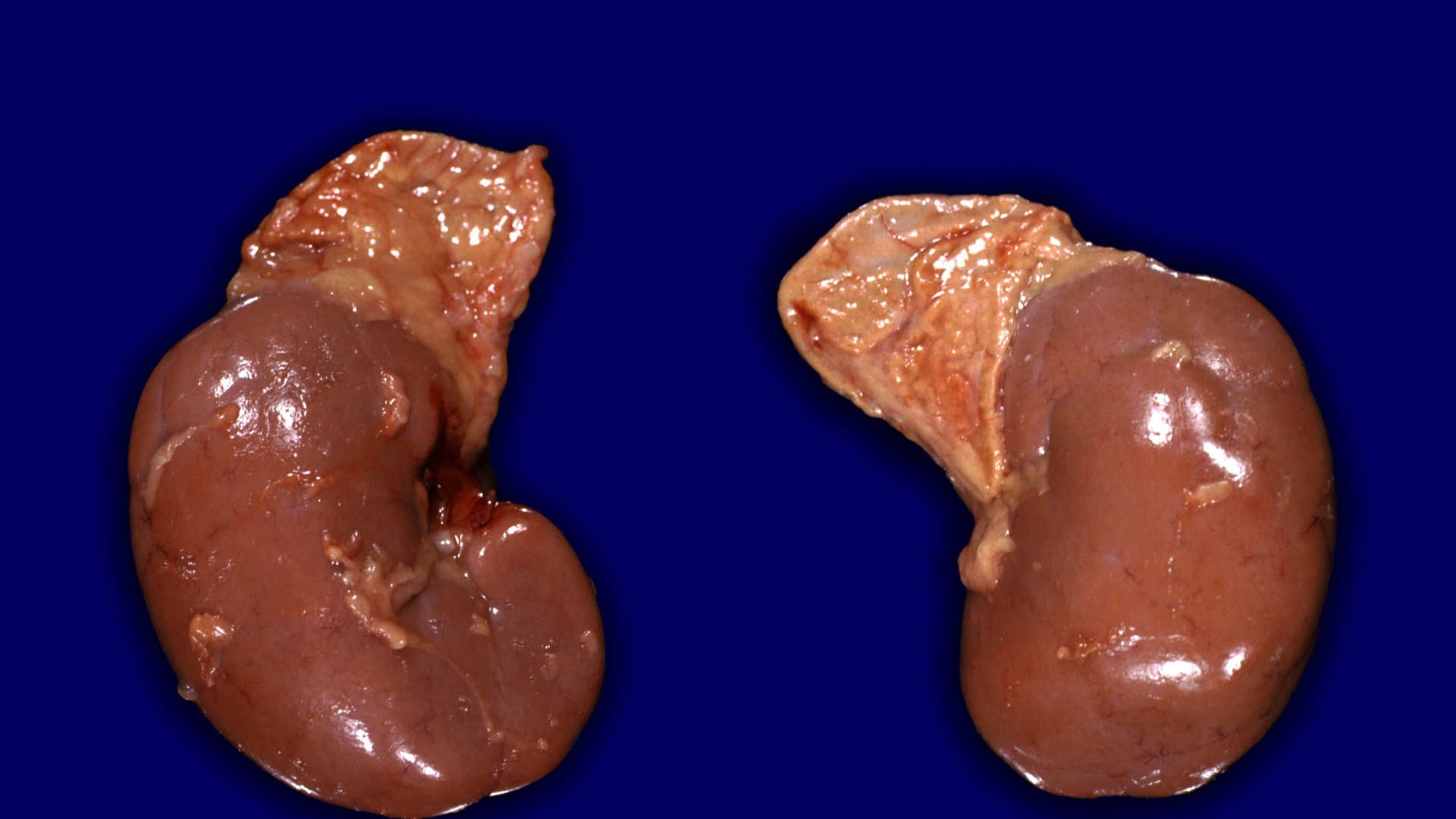 Liver transplant operation
