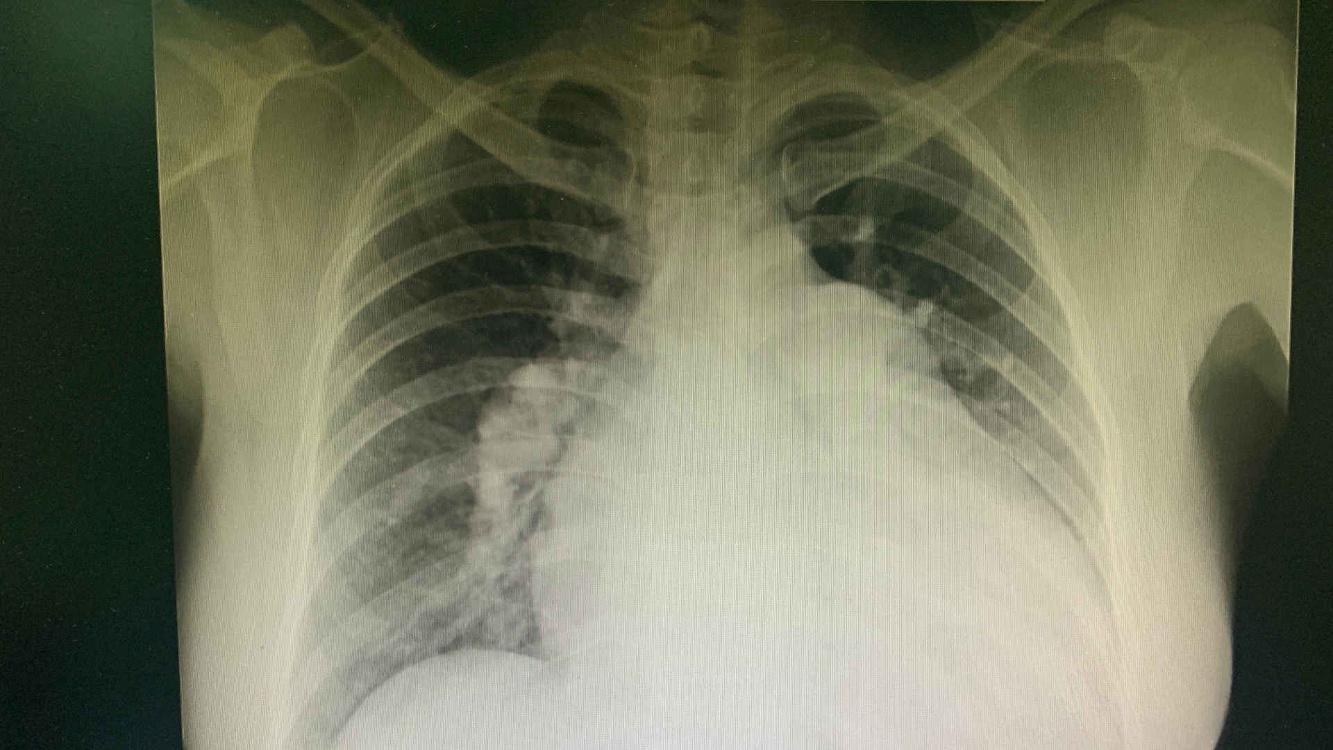 Chest radiograph of a patient with pulmonary hypertension