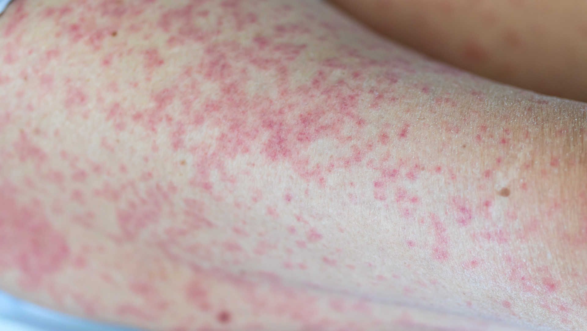 Drug rash on a limb
