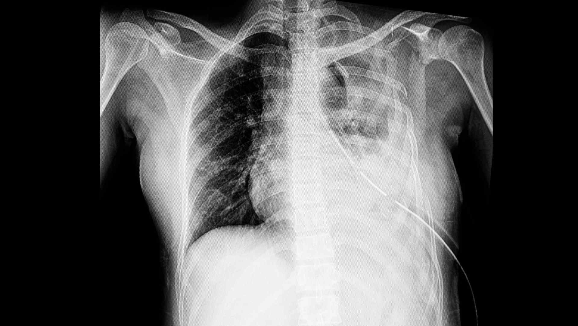 Chext radiograph of a patient with a chest drain and chest trauma