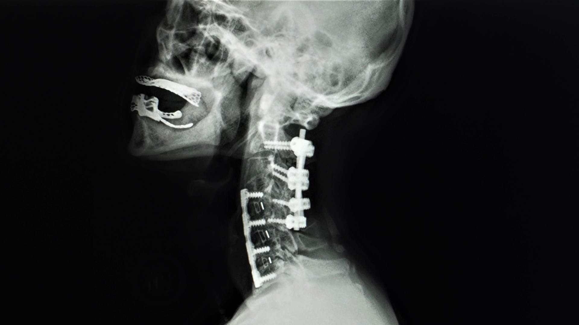 Radiograph of a neck fixation