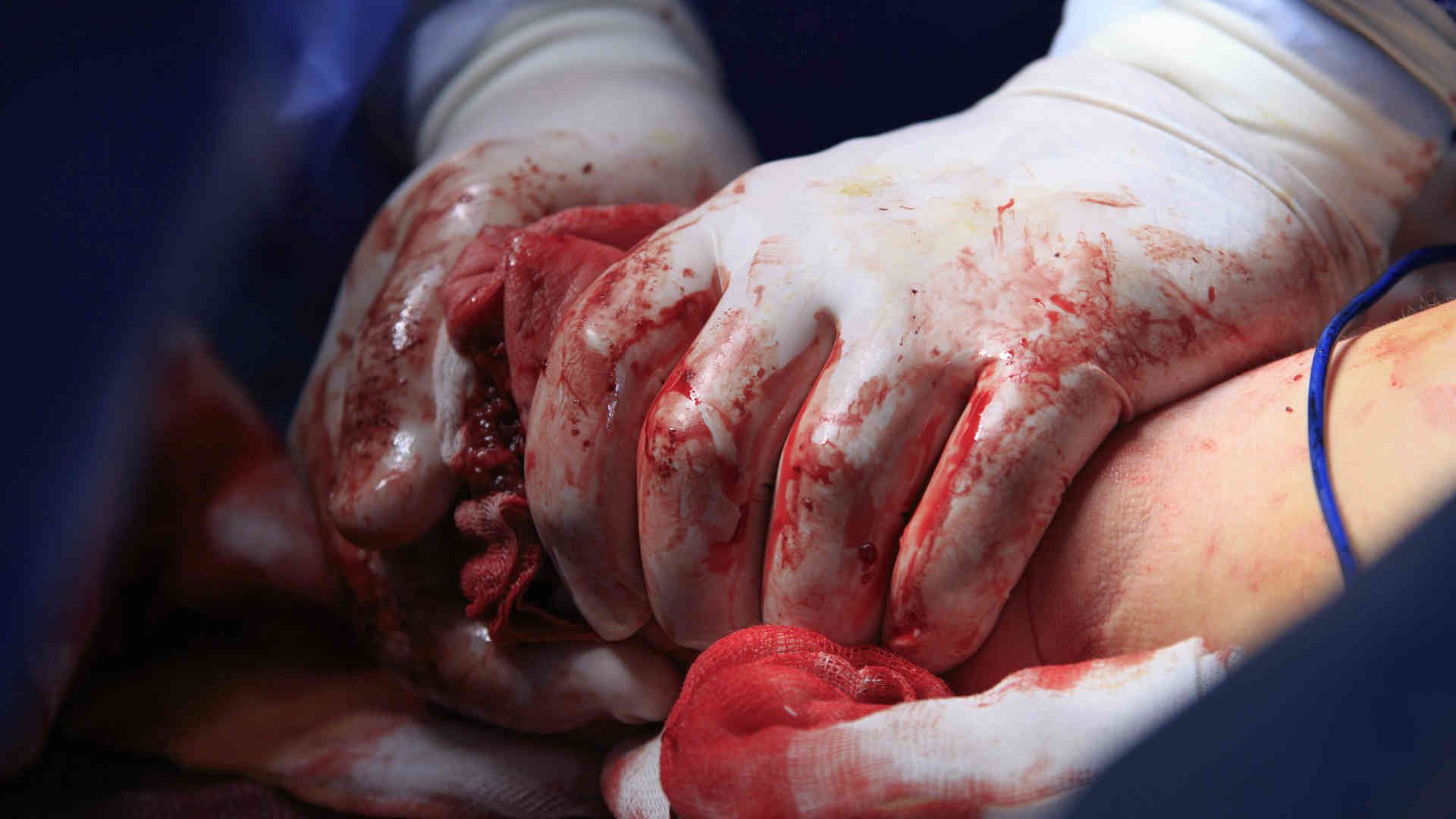 Surgeon squeezing a bleeding limb