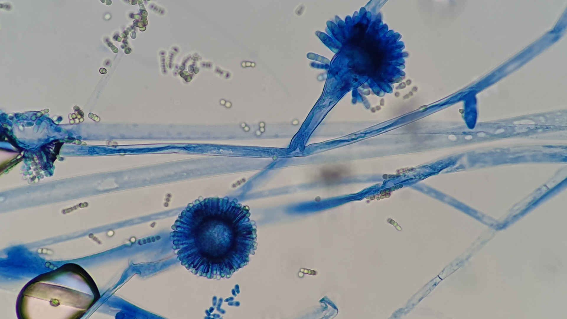 Aspergilloma under the light microscope