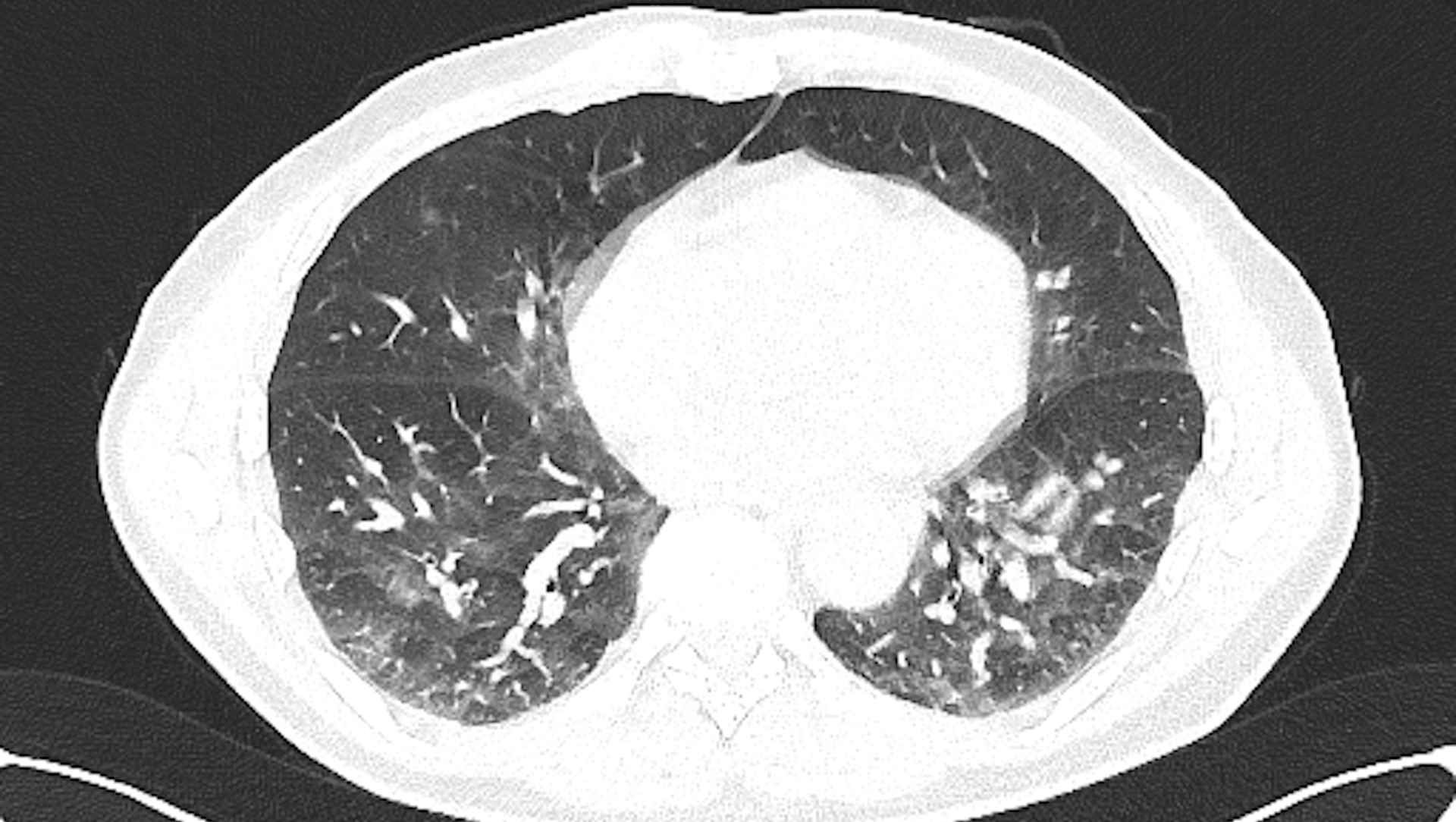 ARDS CT scan